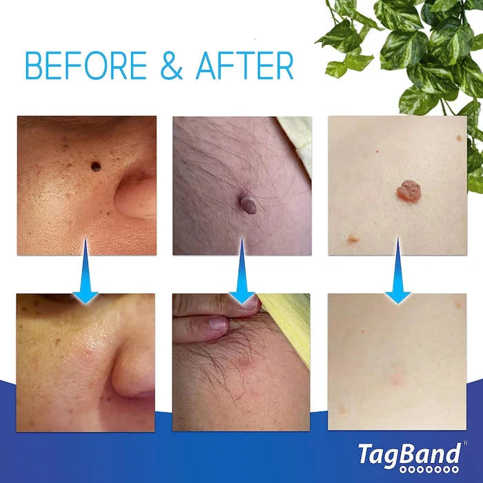 TagBand skin tag removal