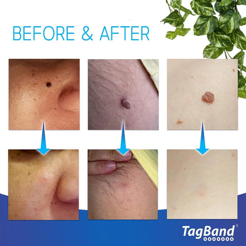 Tagband Large Skin Tag Remover Kit